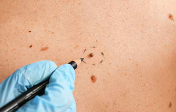 Mole removal: reason for scarring
