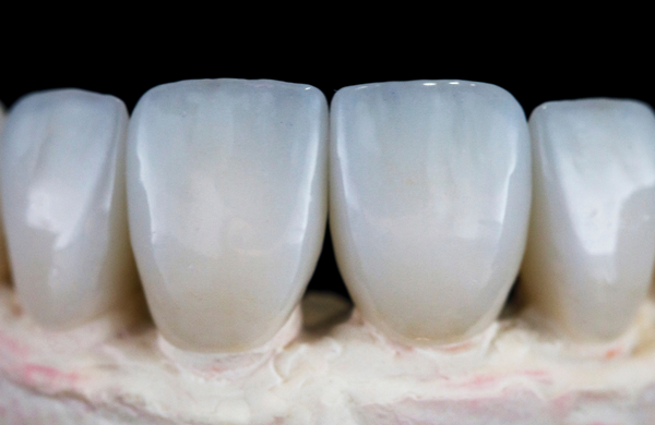 Who can benefit from dental veneers?