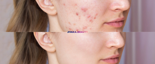 Potenza-RF-Microneedling-Complete-Guide-and-Top-Seoul-clinics -2025