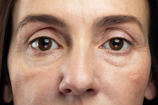 Under-Eye Fat Repositioning Surgery: Let's Talk Honestly About the Side Effects