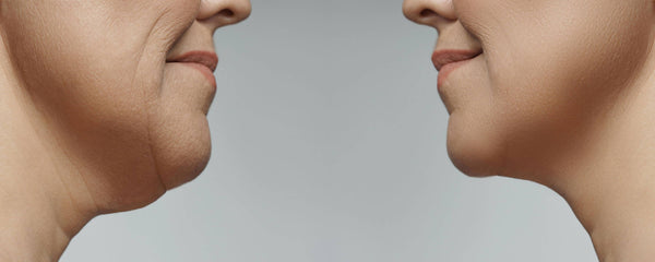 Facial bone contouring surgery in Korea - Jivaka Beauty