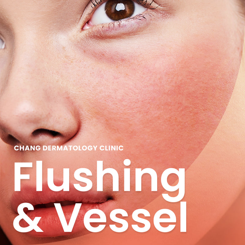 Flushing/Vessel Treatment Laser: Cynergy Multiplex