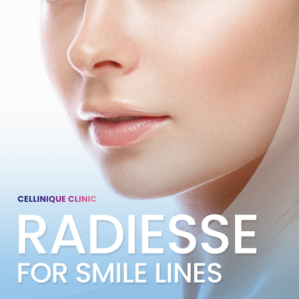 Radiesse for smile lines